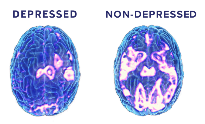 Ketamine Therapy Mental Health Argyle, Texas